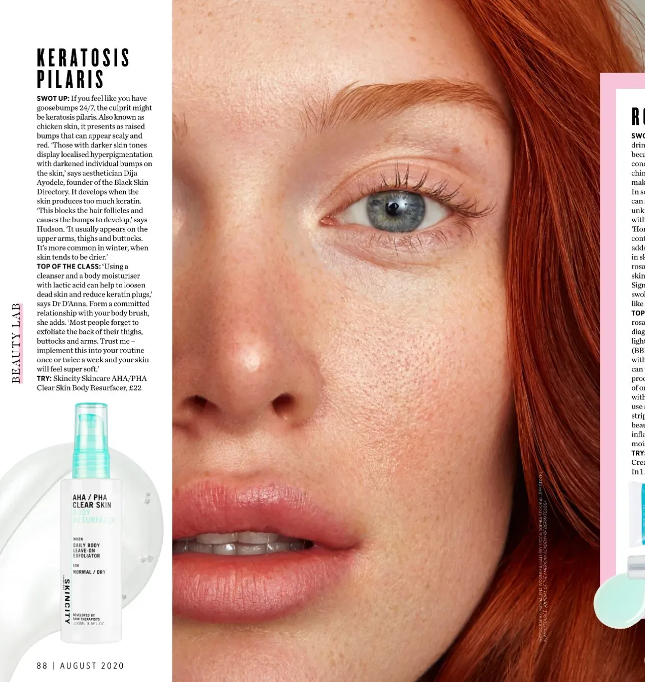 Women's Health — Keratosis